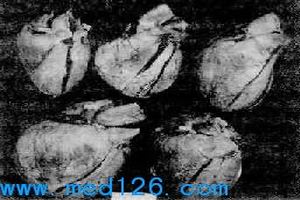 急性肺源性心臟病