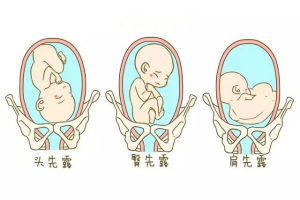 三種胎位不正圖示