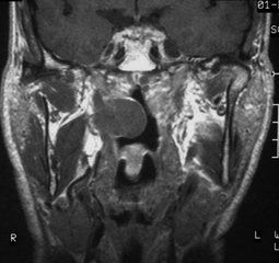鼻咽血管纖維瘤