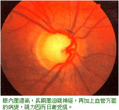 藥物相關性青光眼