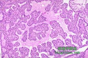 急性化膿性甲狀腺炎