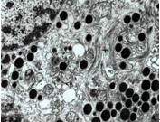 脂蛋白腎小球病