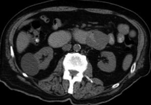 髓系肉瘤 髓系肉瘤