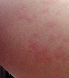 慢性蕁麻疹 慢性蕁麻疹