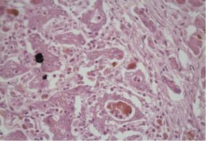 丙型病毒性肝炎