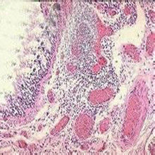 纖毛不動綜合徵