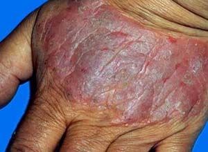 苔蘚樣變 苔蘚樣變