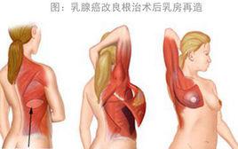 乳腺癌改良根治術 乳腺癌改良根治術