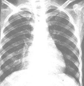 墜積性肺炎 墜積性肺炎