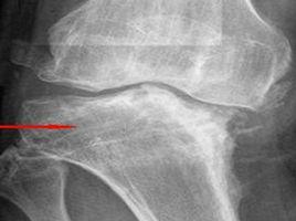 未分化關節炎 未分化關節炎