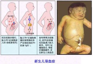 新生兒ABO溶血症