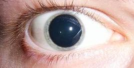 瞳孔放大 瞳孔放大