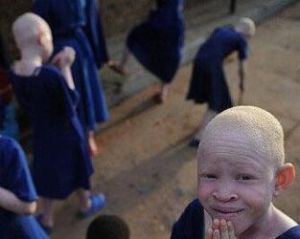 白化病人 白化病人