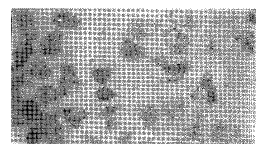 出血熱腎病綜合徵