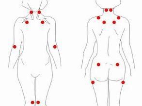 纖維性肌痛綜合症 纖維性肌痛綜合症