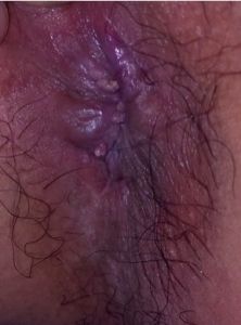 肛門尖銳濕疣 肛門尖銳濕疣