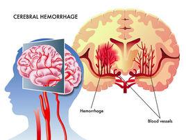 人工昏迷 人工昏迷