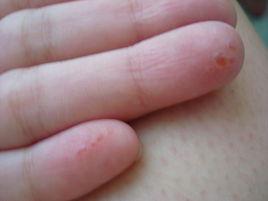 摩擦性水泡 摩擦性水泡