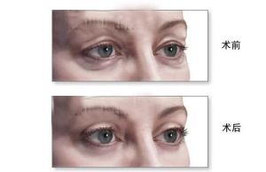 眼袋下垂 眼袋下垂