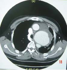 同型胱氨酸尿症