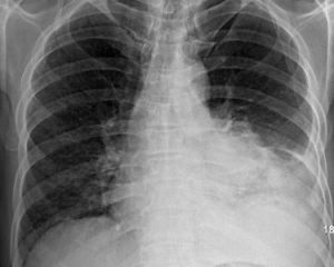 肺良性腫瘤 肺良性腫瘤