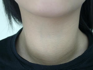 無痛性甲狀腺炎