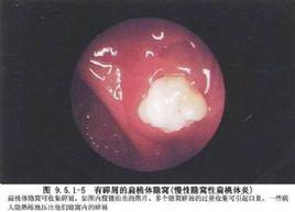 扁桃體角化症 扁桃體角化症