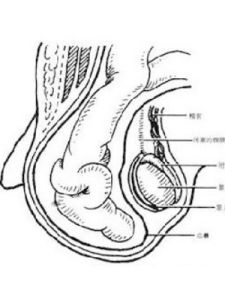 疝氣嵌頓 疝氣嵌頓