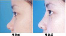 劉彥軍低鼻手術案例