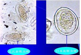 日本分體吸蟲病 日本分體吸蟲病