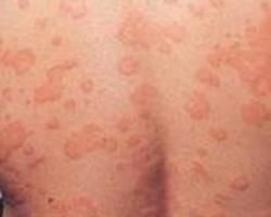 糖尿病皮膚病變