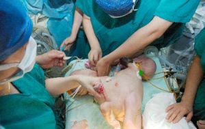 聯體兒“分身”成功