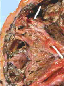 浸潤型肺結核 浸潤型肺結核