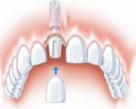 人工口腔種植牙 人工口腔種植牙