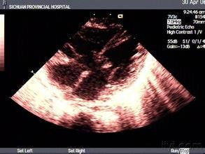 完全性心內膜墊缺損