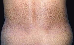 《魚鱗病的治療及保養》