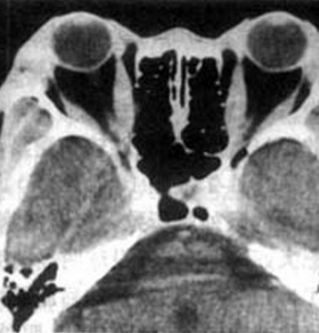 甲狀腺相關眼病