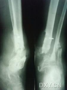 先天性脛骨假關節