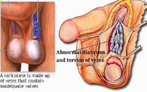 左精索靜脈曲張 左精索靜脈曲張