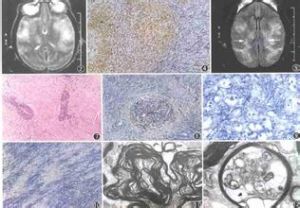 亞急性壞死性脊髓炎綜合症 亞急性壞死性脊髓炎綜合症