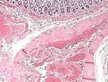 老年人結腸憩室 老年人結腸憩室