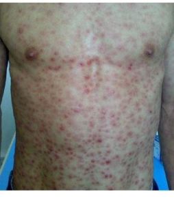 神經梅毒 神經梅毒