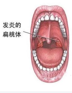 急性扁桃體炎 急性扁桃體炎