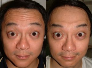 去抬頭紋 去抬頭紋