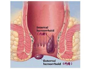 靜脈曲張性外痔 靜脈曲張性外痔