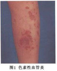 暴發性紫癜 暴發性紫癜