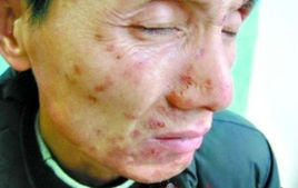 寄生蟲妄想症 寄生蟲妄想症