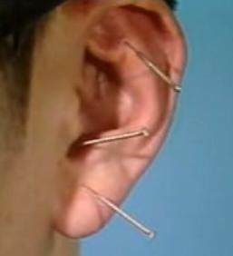 耳針 耳針