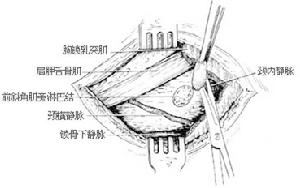 頸部淋巴結切除術