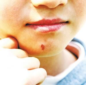 芒果性皮炎 芒果性皮炎